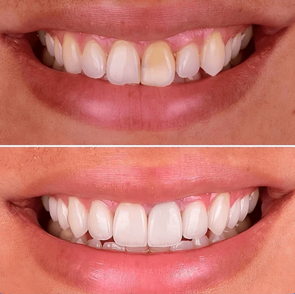 Antes y después de tratamiento con porcelain veneers, mostrando una transformación estética en la sonrisa con mejoras en color, forma y alineación dental.