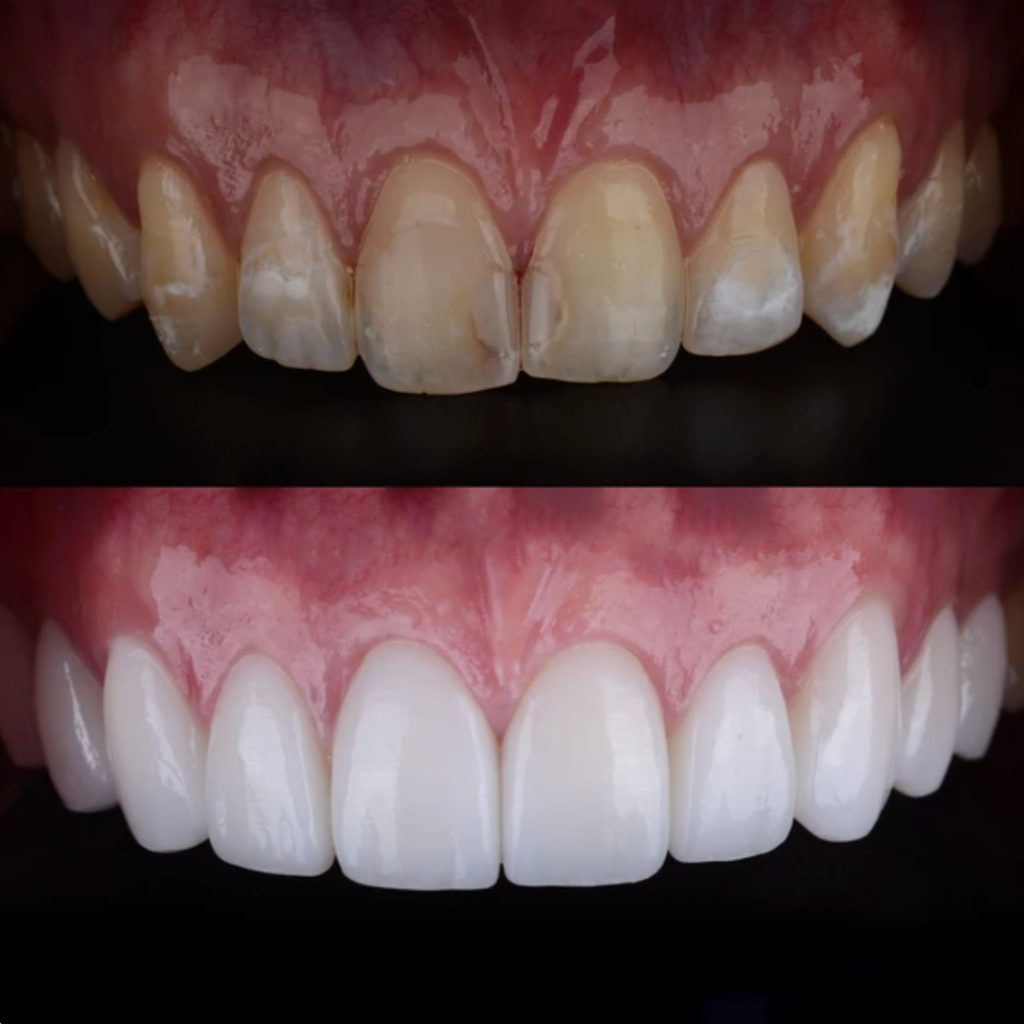 Antes y después de tratamiento con porcelain veneers, mostrando una transformación estética en la sonrisa con mejoras en color, forma y alineación dental.