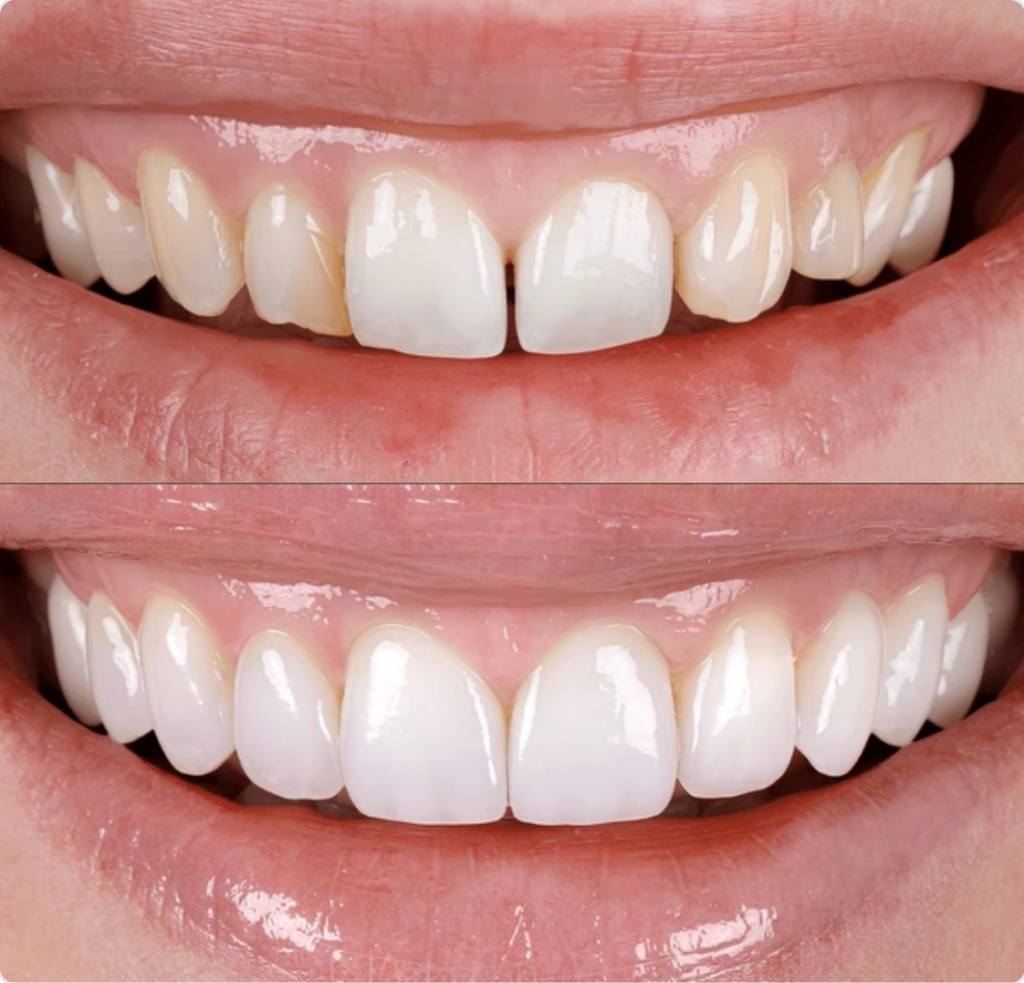 Antes y después de tratamiento con porcelain veneers, mostrando una transformación estética en la sonrisa con mejoras en color, forma y alineación dental.