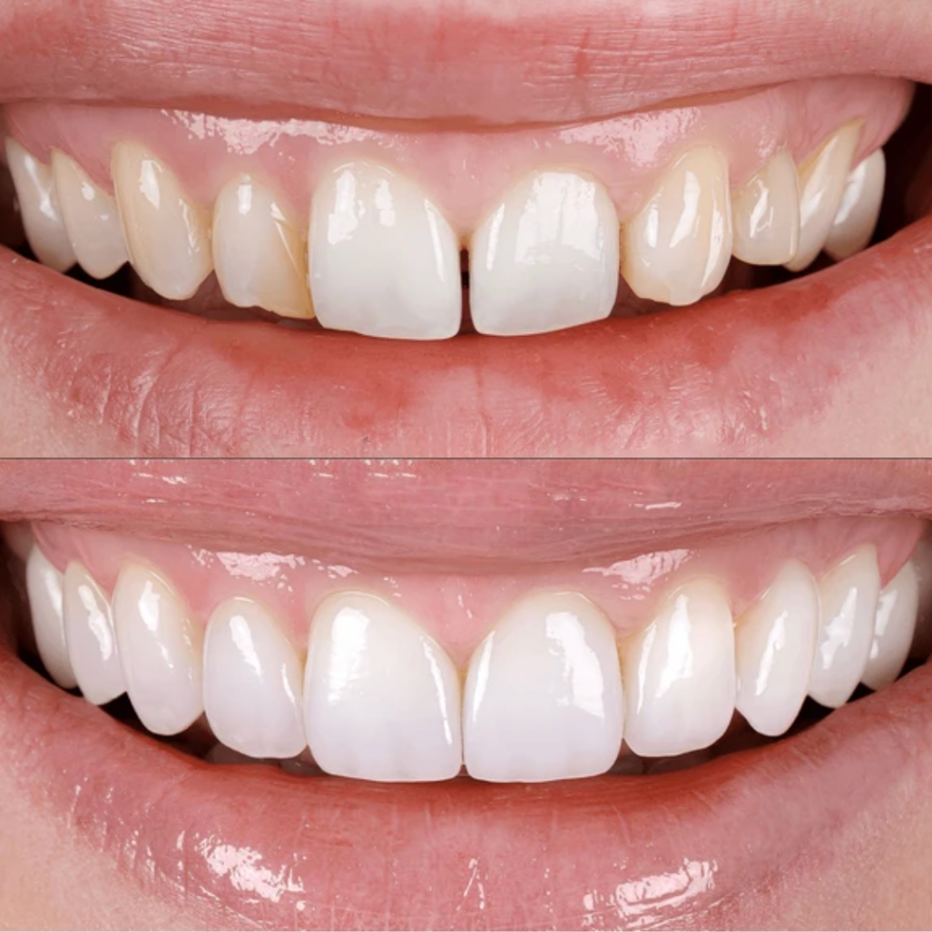 Antes y después de tratamiento con porcelain veneers, mostrando una transformación estética en la sonrisa con mejoras en color, forma y alineación dental.